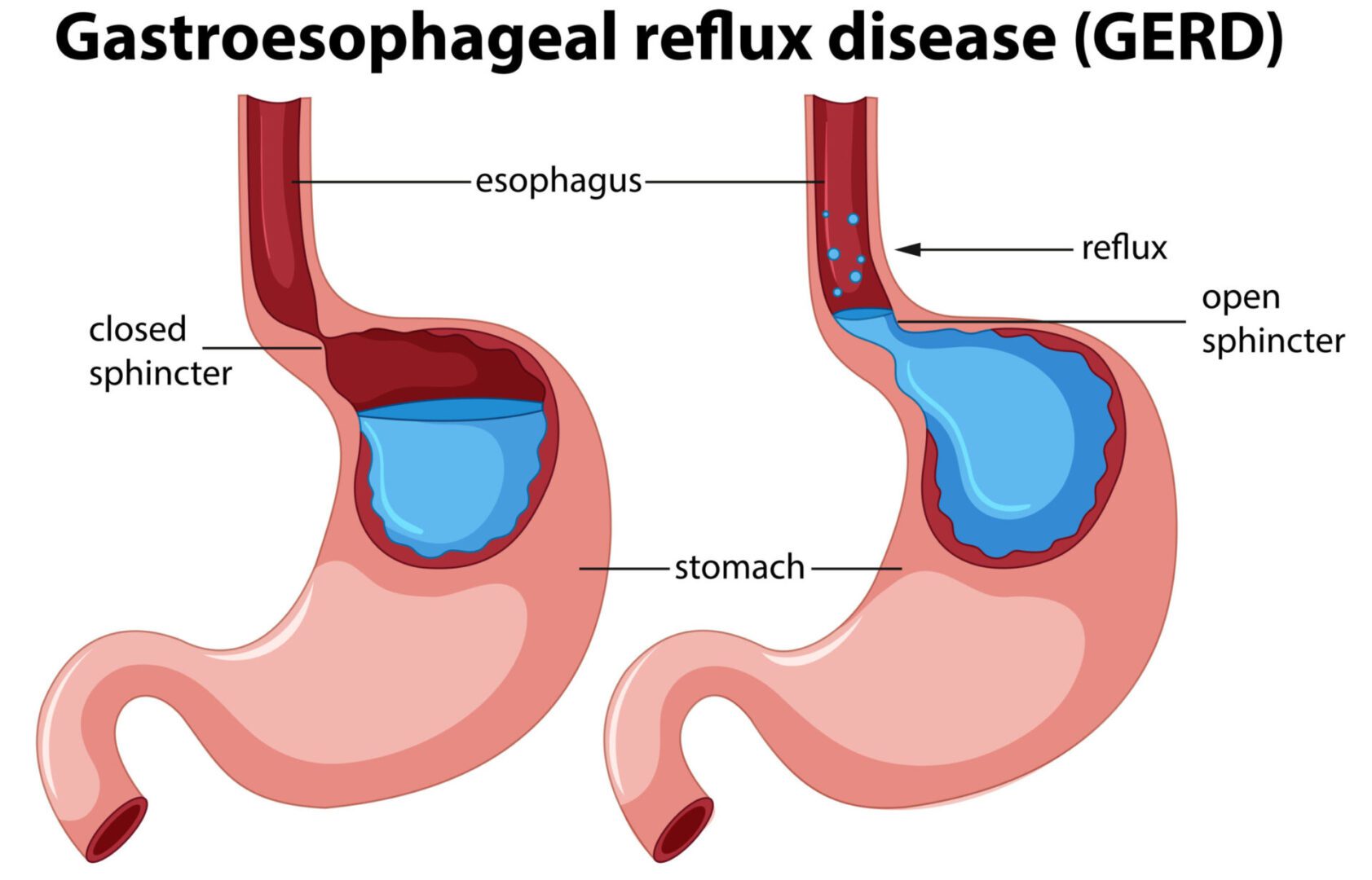 A diagram of stomach showing Gastroesophageal Reflux Disease Gerd