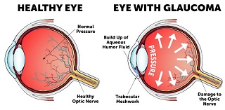 Diagrams of healthy eye and eye with Glaucoma