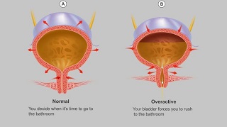 Overactive Bladder Oab Normal and Overactive