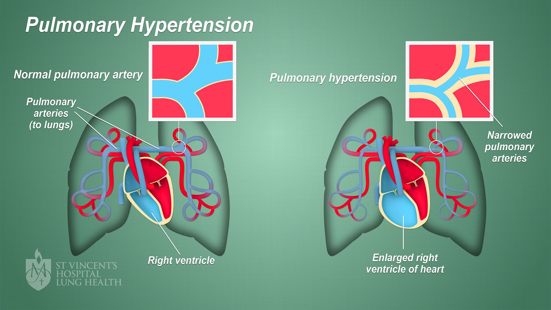 Pulmonary Hypertension - Plants Cures