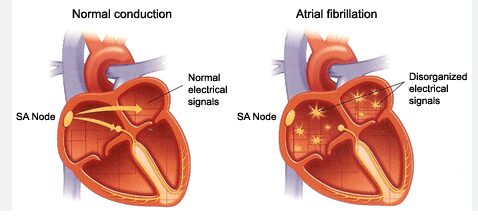 Atrial Fibrillation (AFIB) - Plants Cures